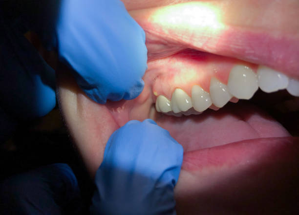 Best Emergency Tooth Extraction in Central Gardens, TX